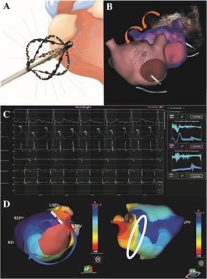 Charge density mapping demonstrates superiority in catheter ablation of post-surgical atrial tachycardias